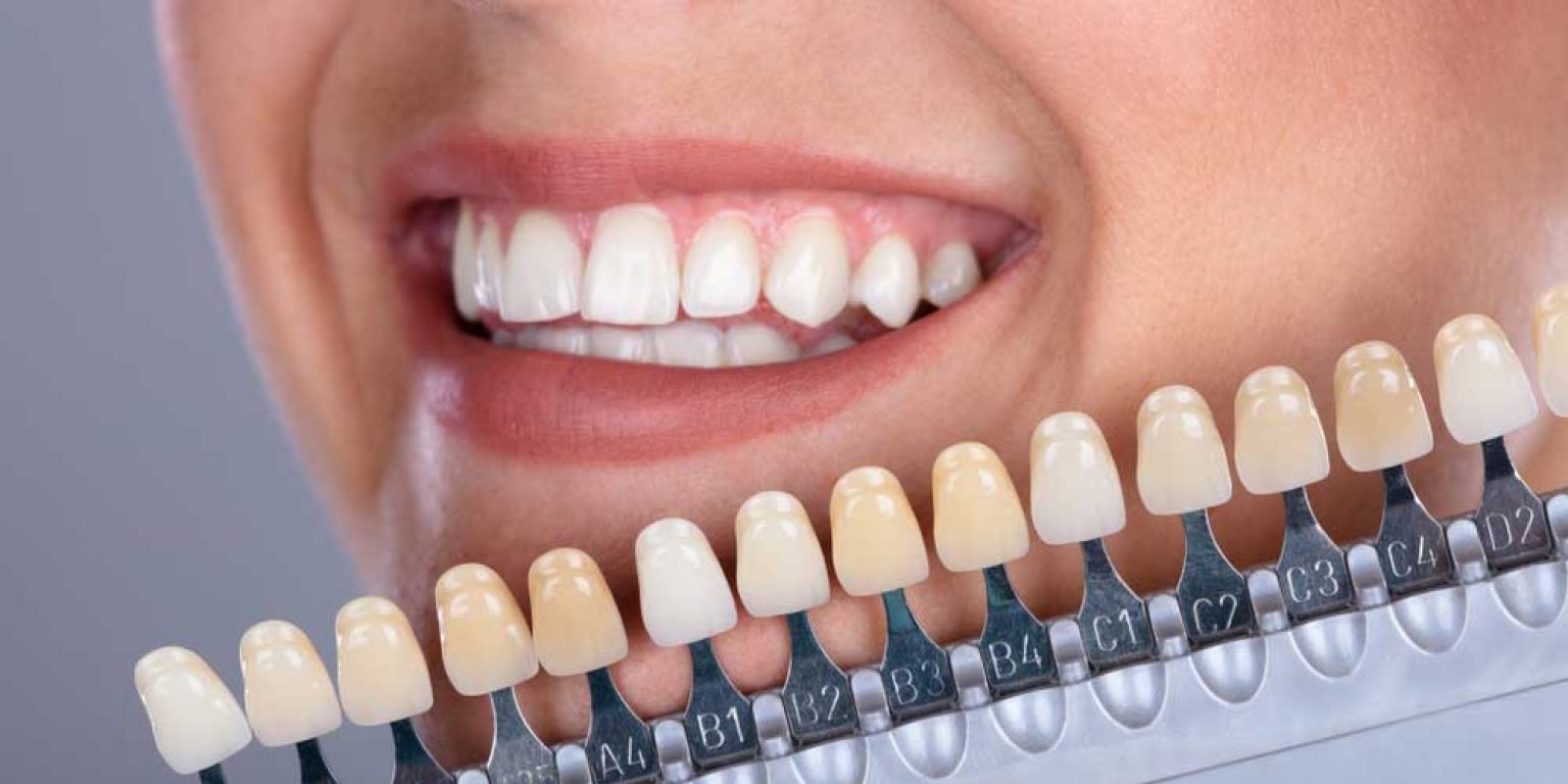 The Incredible Aesthetic Benefits of Dental Implants Bullide