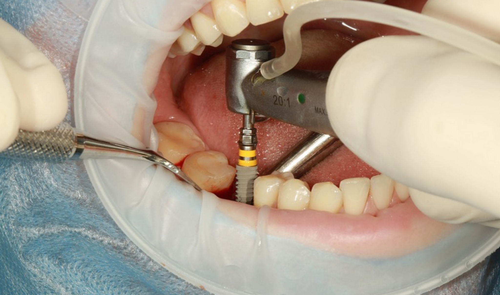 4 Best Dental Implant Dentists in Michigan Bullide