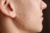 Acne Scar Removal Treatments