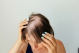 Symptoms and Treatment Of Alopecia