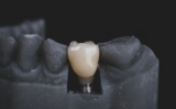 5 Best Dental Implant Dentists in California