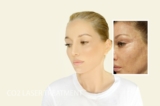 CO2 Laser Treatment
