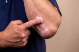 Psoriasis Causes And Remedies Of 2023