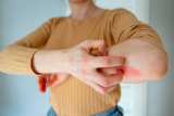 Natural Remedies For Eczema
