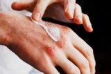 Effective Treatment Strategies for Atopic Dermatitis