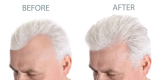 Best Hair Transplant Solutions For Seniors