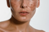 Hyperpigmentation