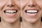 Orthodontics Options For Beautiful Teeth