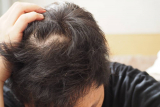 How To Prevent Hair Loss For Women
