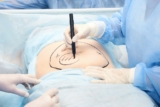Tummy Tuck Treatments and Prices
