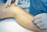 Varicose Vein Treatments