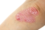 What Does Psoriasis Look Like